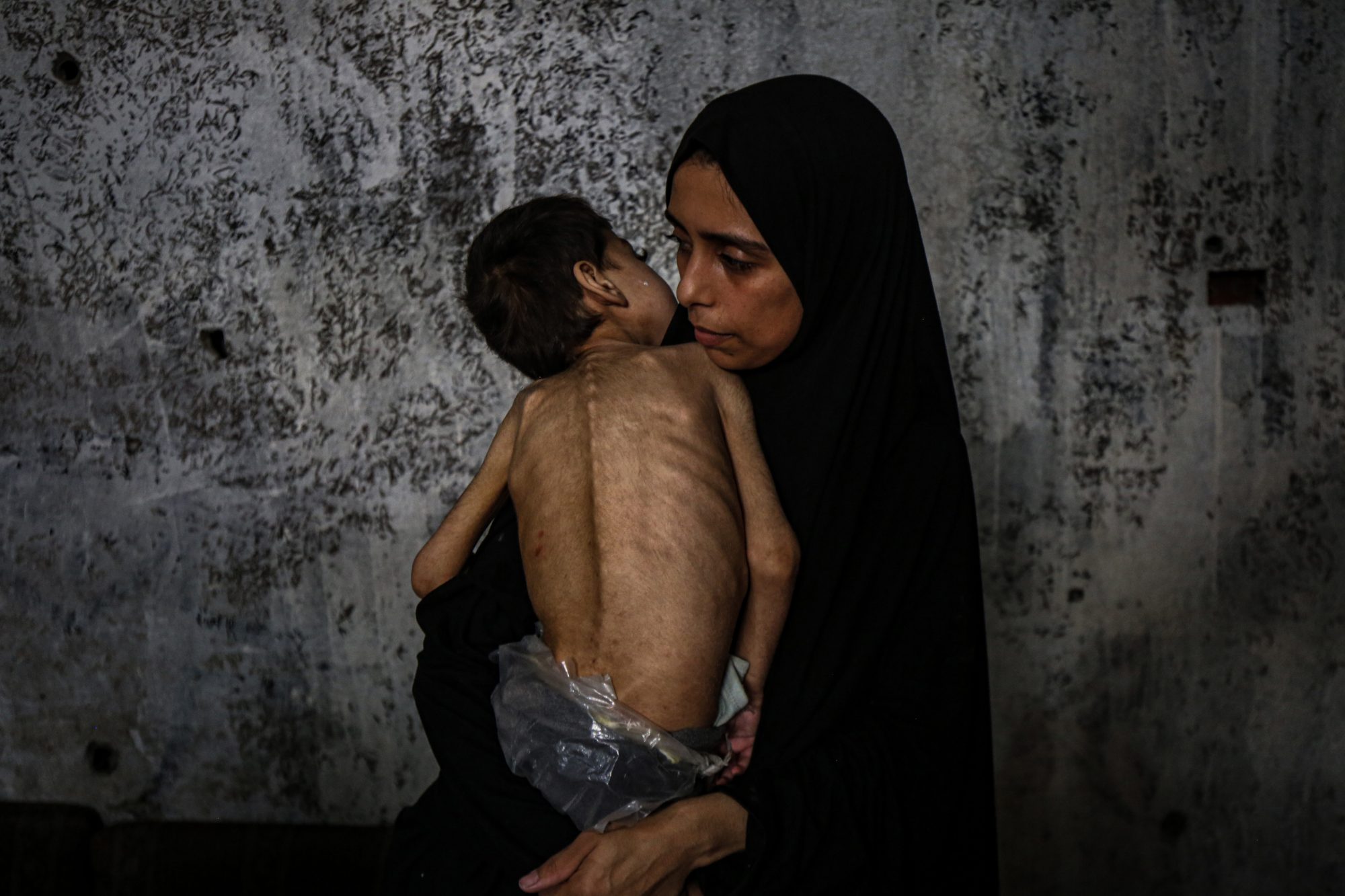 I due fratelli, Youssef Abdel Rahman Matar (6 anni) e Amir Abdel Rahman Matar (4 anni), affetti da disabilità intellettive e fisiche, sono accuditi dalla madre all'interno di una scuola che ospita famiglie sfollate a Gaza City. Sono affetti da grave malnutrizione, potenzialmente fatale, a causa del peggioramento delle condizioni umanitarie nella Striscia di Gaza dovuto ai continui attacchi israeliani e al prolungato blocco. La loro salute continua a peggiorare poiché Israele ha mantenuto chiusi i valichi di frontiera da marzo, impedendo l'ingresso di aiuti alimentari. I medici avvertono che le loro vite sono a rischio se non ricevono cure mediche urgenti. (Omar Ashtawy/Ipa/Fotogramma)