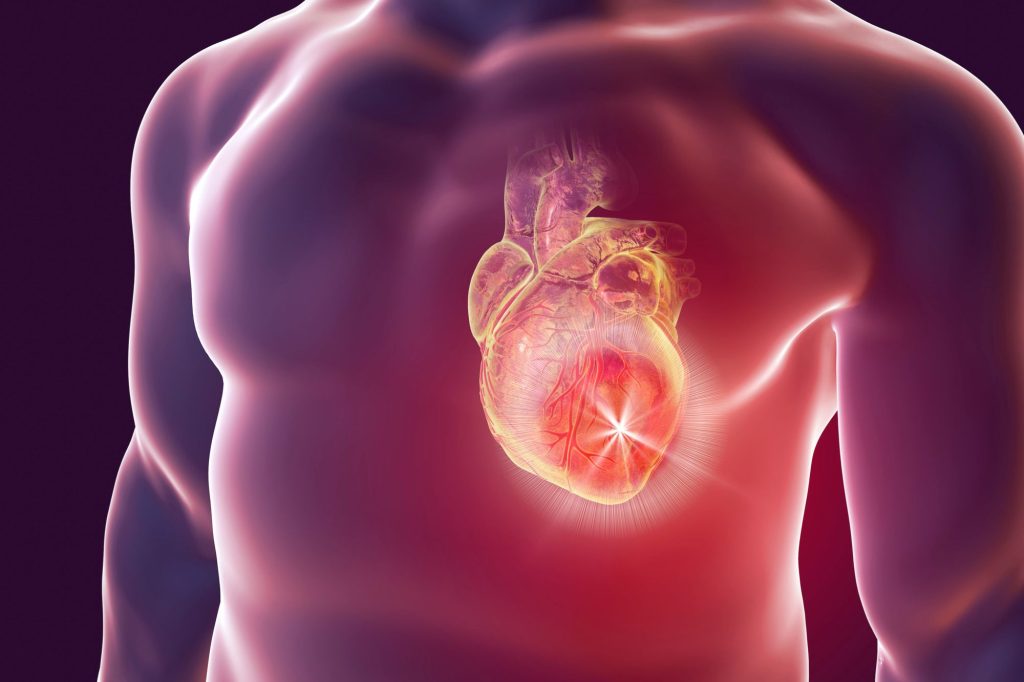 Arresto Cardiaco Canva